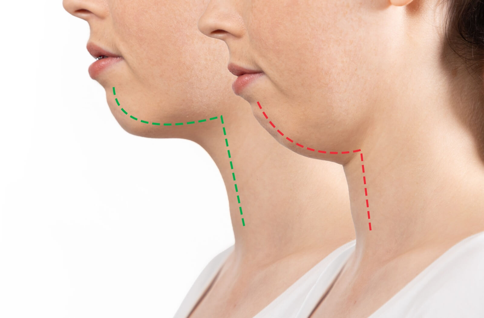 A rare example of a dramatic jaw change shows the kinds of adjustments that may happen.