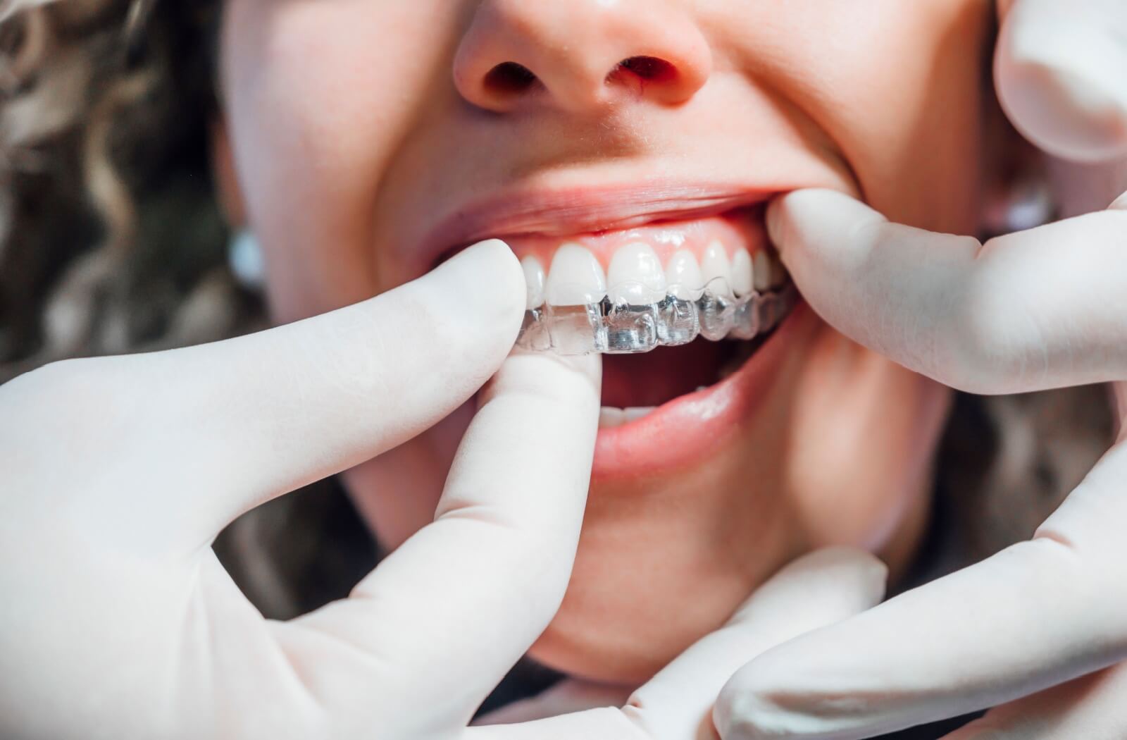 Close-up of a dental professional fitting Invisalign aligners on a patient wearing gloves