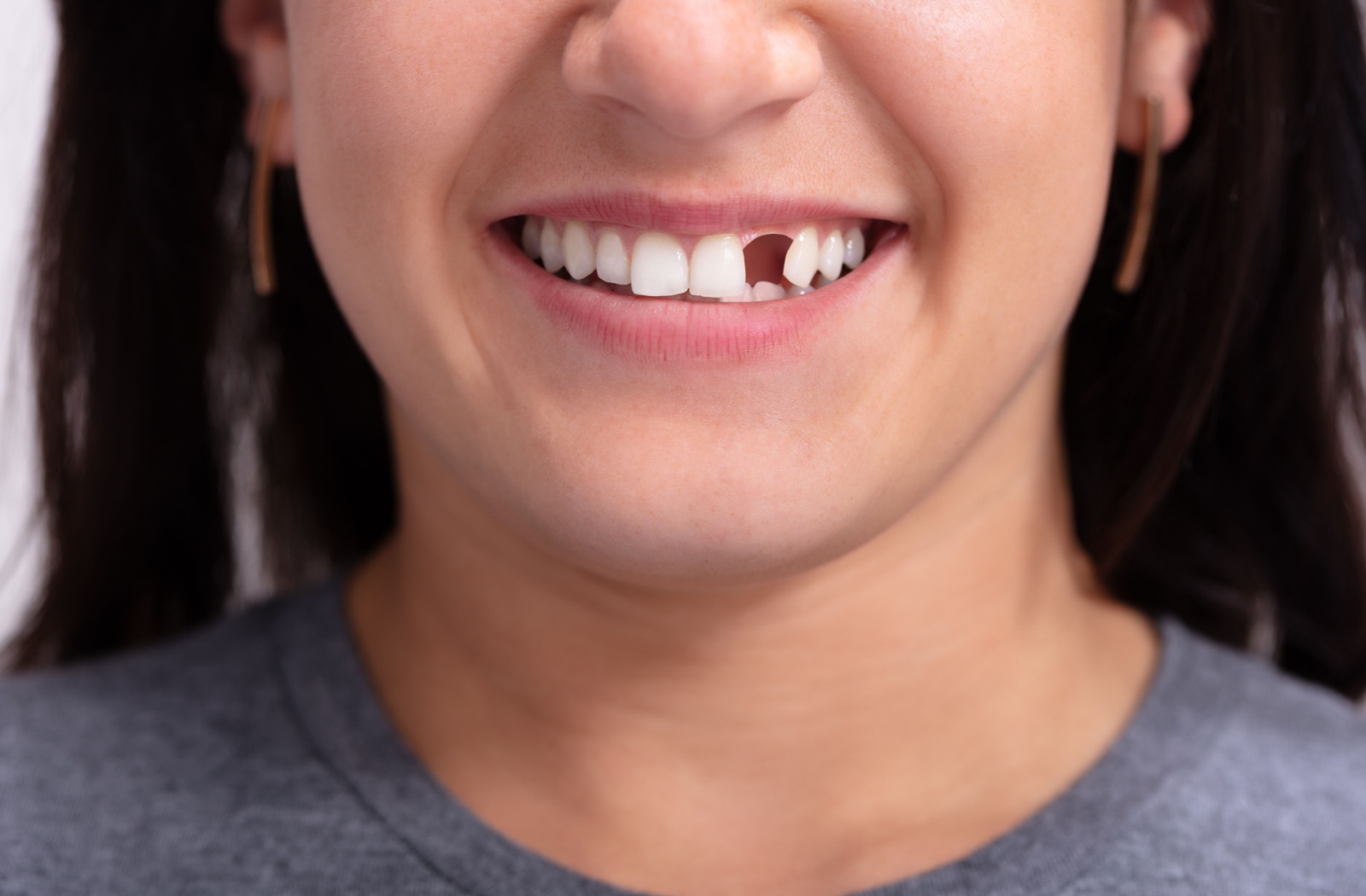 Close-up of a person with a missing tooth smiling confidently